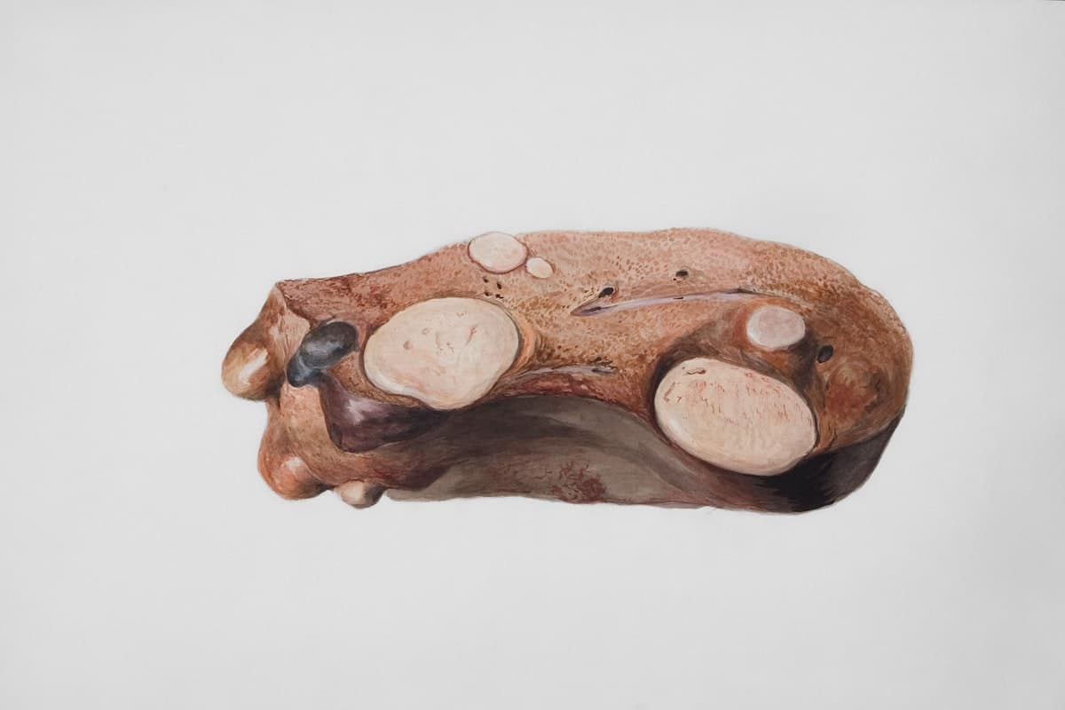 زراعة الكبد من متبرع حي في تركيا